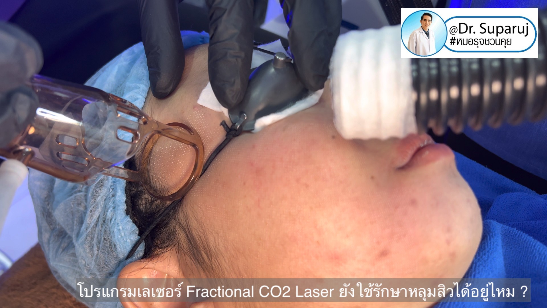 โปรแกรมเลเซอร์ Fractional CO2 Laser ยังใช้รักษาหลุมสิวได้อยู่ไหม ?