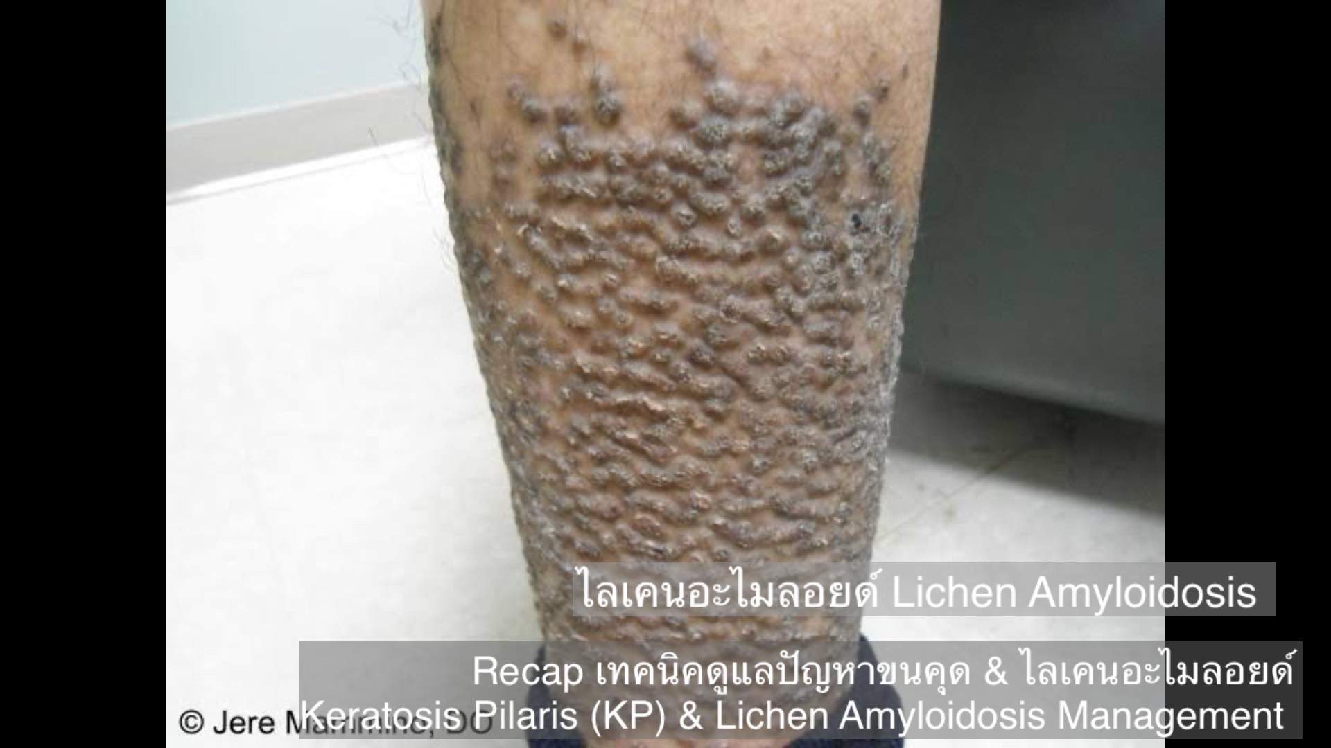 Recap เทคนิคดูแลปัญหาขนคุด & ไลเคนอะไมลอยด์  Keratosis Pilaris (KP) & Lichen Amyloidosis Management