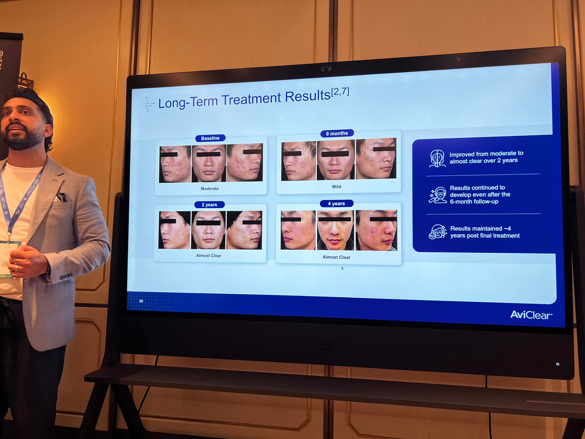 Update เครื่องเลเซอร์สำหรับรักษาสิวโดยเฉพาะ จับกับต่อมไขมันโดยตรง = AviClear 1726 nm Laser Update เครื่องเลเซอร์สำหรับรักษาสิวโดยเฉพาะ จับกับต่อมไขมันโดยตรง = AviClear 1726 nm Laser