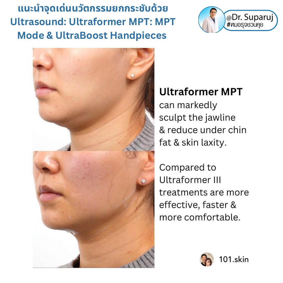 แนะนำนวัตกรรม พลังงานเครื่องเสียง Macro & Micro Focused Ultrasound ยกกระชับผิว Ultraformer MPT: จุดเด่น + ทดสอบลักษณะพลังงาน + การประเมินลักษณะผิว ให้เห็นกันชัดๆเลยครับ