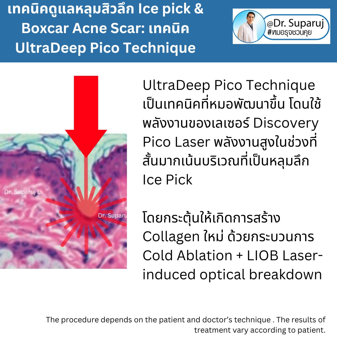 แนะนำเทคนิครักษาหลุมสิวจิกลึก Ice Pick Acne Scar ด้วยเทคนิคเลเซอร์ UltraDeep Pico Technique (Ice Pick Acne Scar Treatment with Discovery Pico Laser + UltraDeep Pico Technique)  แนะนำเทคนิครักษาหลุมสิวจิกลึก Ice Pick Acne Scar ด้วยเทคนิคเลเซอร์ UltraDeep Pico Technique (Ice Pick Acne Scar Treatment with Discovery Pico Laser + UltraDeep Pico Technique)