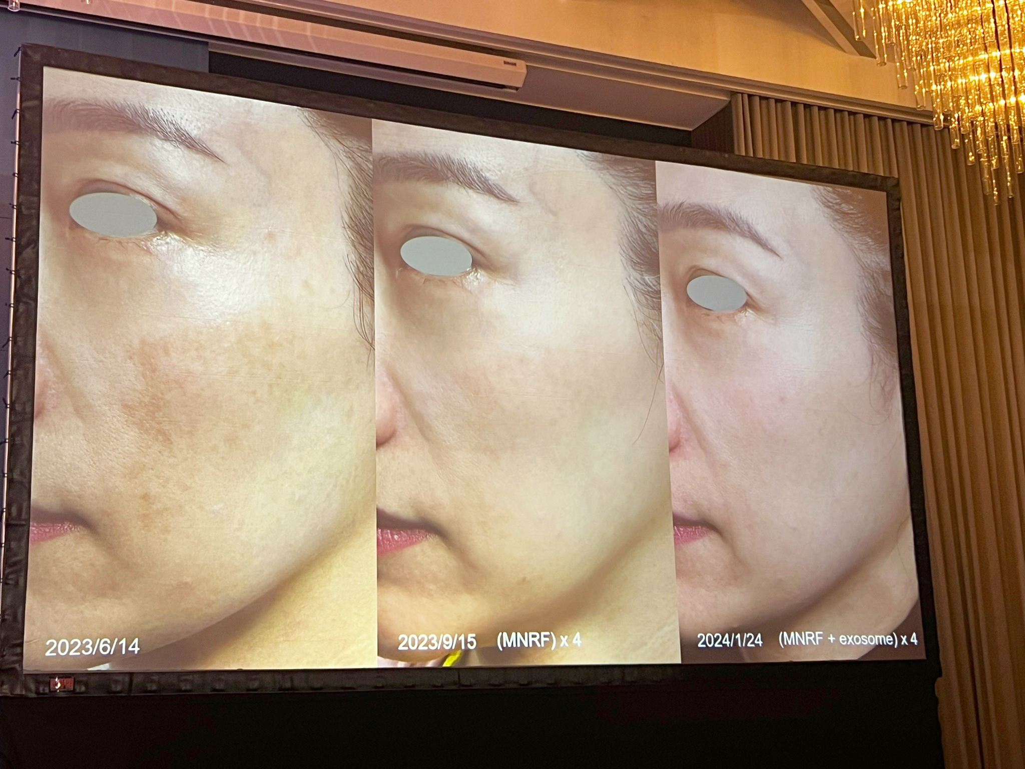 หมอรุจ ผศ. นพ. ศุภะรุจ เลื่องอรุณ ได้รับเกียรติร่วมบรรยายแชร์เทคนิคการดูแลปัญหาผิวหนัง เช่น หลุมสิว แผลเป็น ปัญหาเส้นผม ฝ้า กับแพทย์ผู้เชี่ยวชาญระดับแนวหน้าของประเทศไต้หวัน เช่น หมอรุจ ผศ. นพ. ศุภะรุจ เลื่องอรุณ ได้รับเกียรติร่วมบรรยายแชร์เทคนิคการดูแลปัญหาผิวหนัง เช่น หลุมสิว แผลเป็น ปัญหาเส้นผม ฝ้า กับแพทย์ผู้เชี่ยวชาญระดับแนวหน้าของประเทศไต้หวัน เช่น