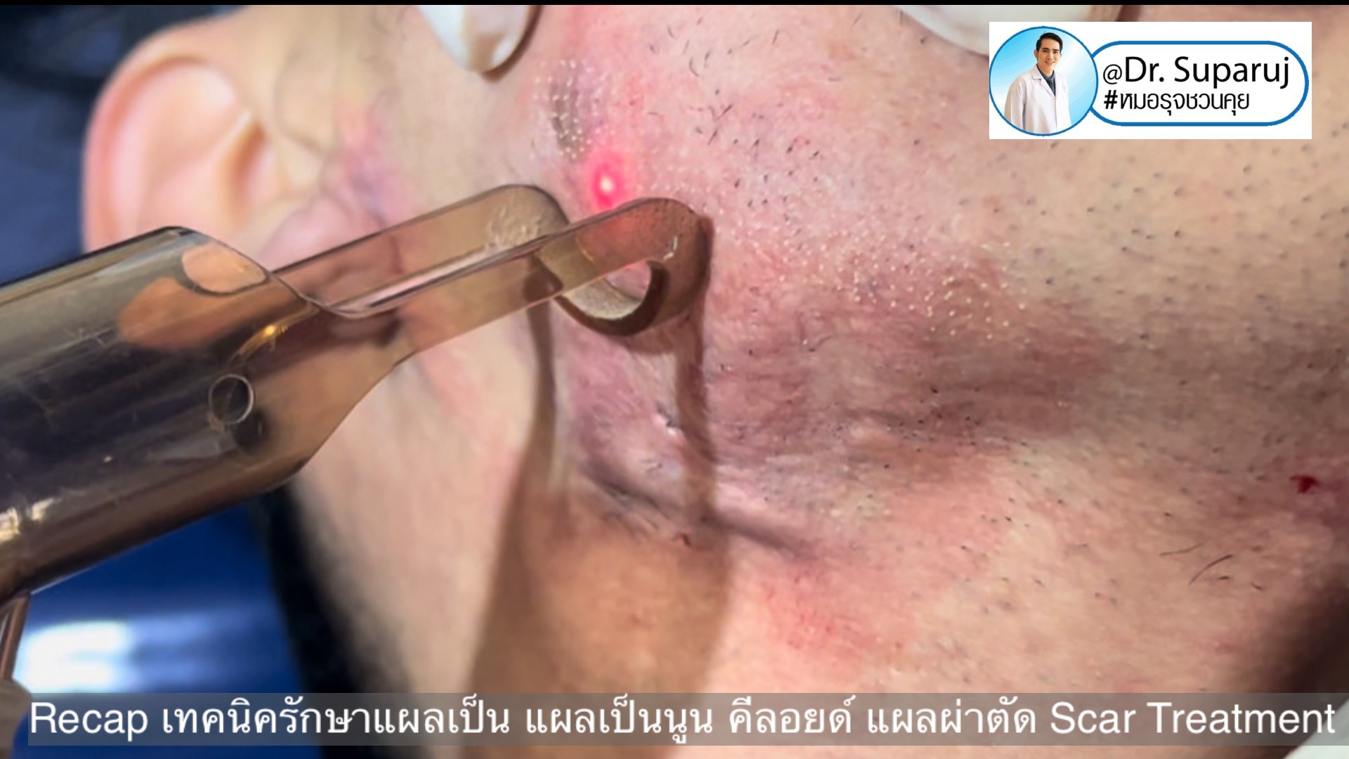 Recap เทคนิครักษาแผลเป็น แผลเป็นนูน คีลอยด์ แผลผ่าตัด Scar Treatment Recap เทคนิครักษาแผลเป็น แผลเป็นนูน คีลอยด์ แผลผ่าตัด Scar Treatment
