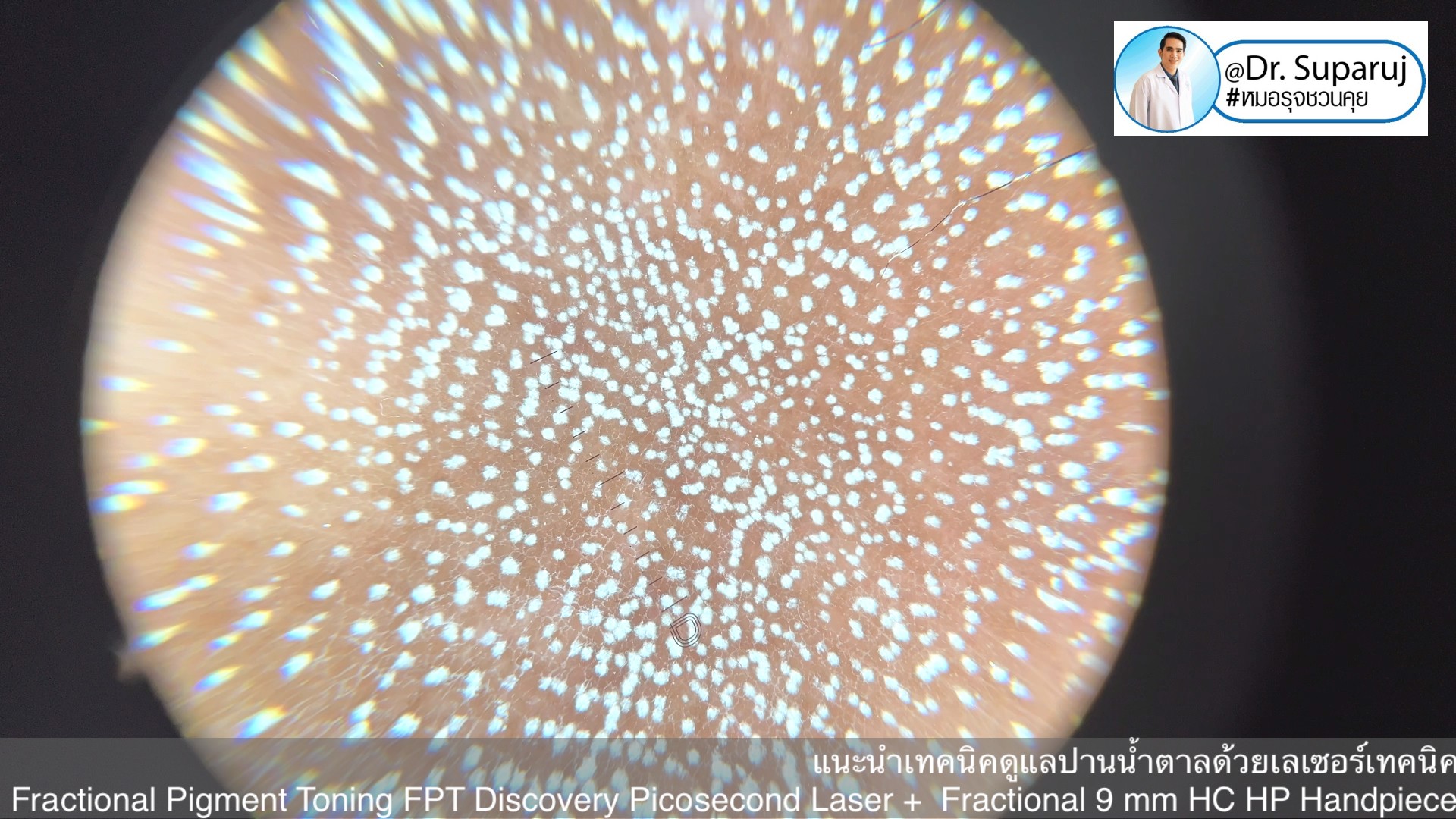 แนะนำเทคนิคดูแลปานน้ำตาล ด้วยเลเซอร์เทคนิค Fractional Pigment Toning FPT Discovery Picosecond Laser + Fractional 9 mm HC HP Handpiece แนะนำเทคนิคดูแลปานน้ำตาล ด้วยเลเซอร์เทคนิค Fractional Pigment Toning FPT Discovery Picosecond Laser + Fractional 9 mm HC HP Handpiece