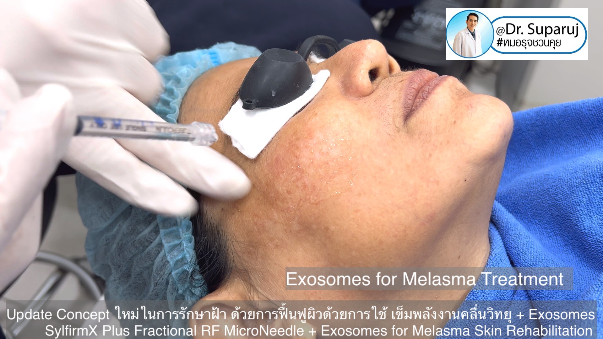 Update Concept ใหม่ในการรักษาฝ้า ด้วยการฟื้นฟูผิวด้วยการใช้ เข็มพลังงานคลื่นวิทยุ + Exosomes (SylfirmX Plus Fractional RF MicroNeedle + Exosomes for Melasma Skin Rehabilitation) Update Concept ใหม่ในการรักษาฝ้า ด้วยการฟื้นฟูผิวด้วยการใช้ เข็มพลังงานคลื่นวิทยุ + Exosomes (SylfirmX Plus Fractional RF MicroNeedle + Exosomes for Melasma Skin Rehabilitation)
