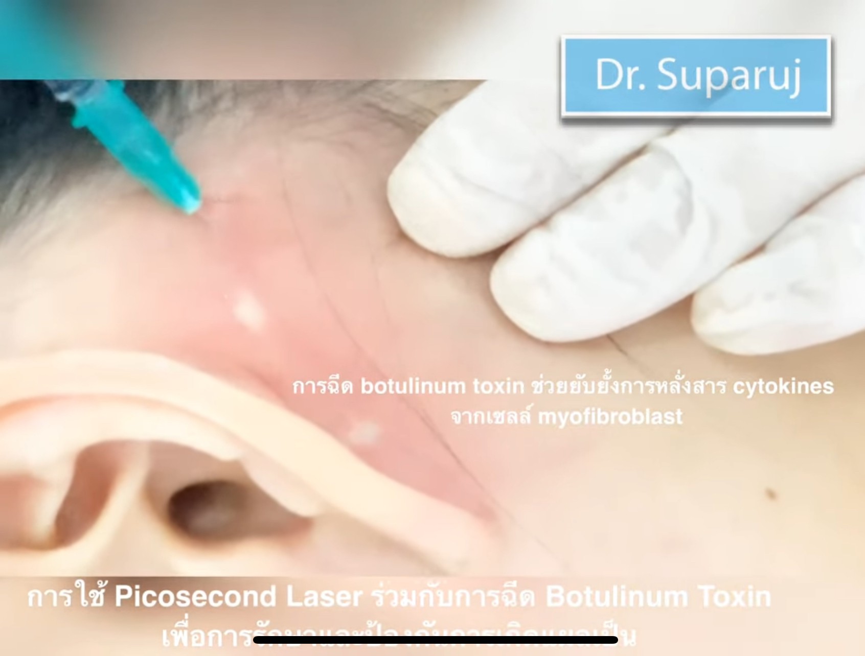 Update เทคนิครักษาแผลเป็นนูนคีลอยด์แผลผ่าตัดด้วยการใช้หลายเลเซอร์ร่วมกัน + เทคนิคการใช้การฉีดโบทูลินัมท็อกซิน (Botox) รักษาแผลเป็นนูนคีลอยด์ Update เทคนิครักษาแผลเป็นนูนคีลอยด์แผลผ่าตัดด้วยการใช้หลายเลเซอร์ร่วมกัน + เทคนิคการใช้การฉีดโบทูลินัมท็อกซิน (Botox) รักษาแผลเป็นนูนคีลอยด์