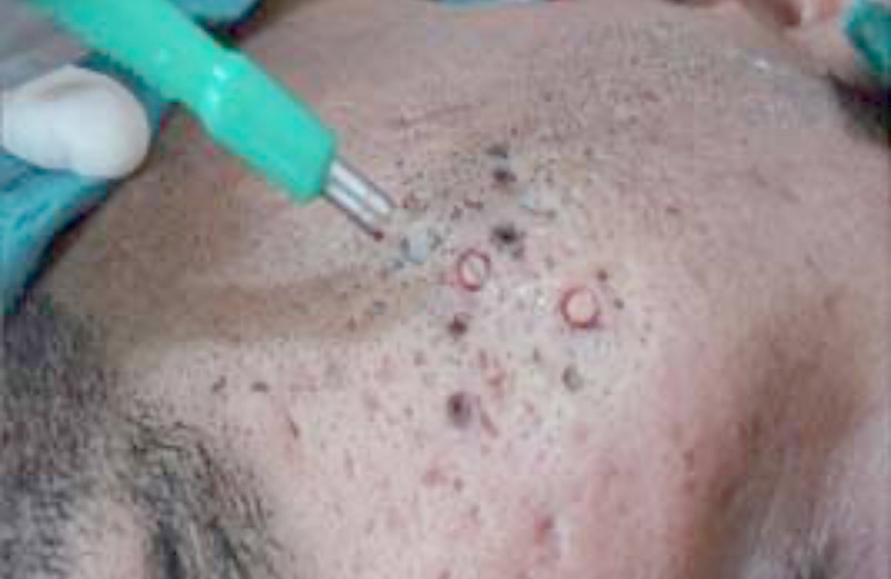 แผลเป็นจากสิวที่มีลักษณะสีขาว severe fibrotic acne scar เกิดจากอะไร & ดูแลได้อย่างไร ?