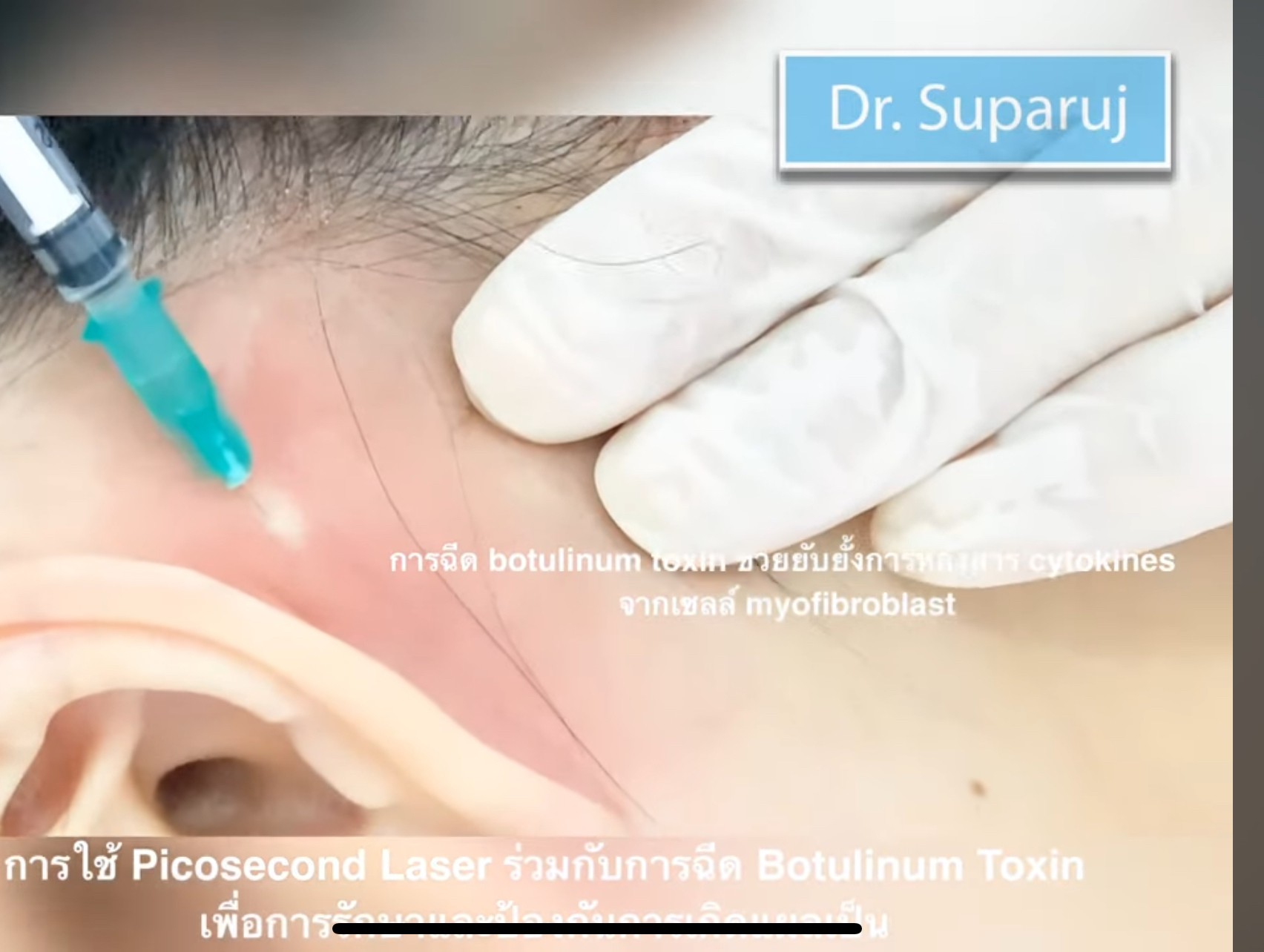 Update เทคนิครักษาแผลเป็นนูนคีลอยด์แผลผ่าตัดด้วยการใช้หลายเลเซอร์ร่วมกัน + เทคนิคการใช้การฉีดโบทูลินัมท็อกซิน (Botox) รักษาแผลเป็นนูนคีลอยด์ Update เทคนิครักษาแผลเป็นนูนคีลอยด์แผลผ่าตัดด้วยการใช้หลายเลเซอร์ร่วมกัน + เทคนิคการใช้การฉีดโบทูลินัมท็อกซิน (Botox) รักษาแผลเป็นนูนคีลอยด์