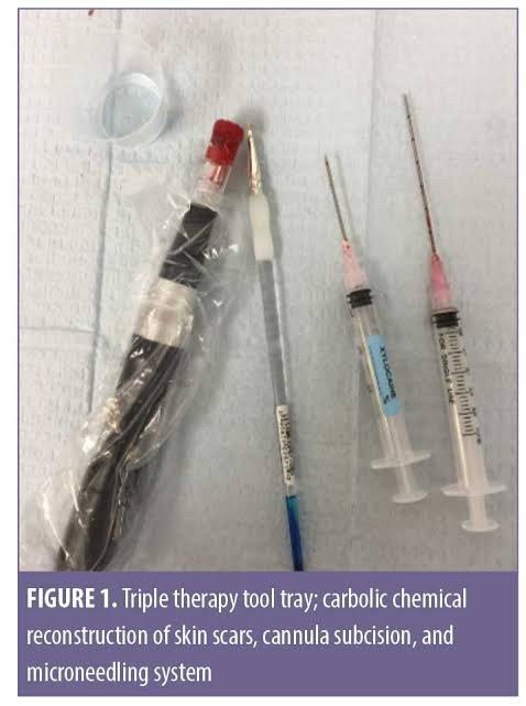 Update เทคนิค Subcision ตัดพังผืดรักษาหลุมสิว Acne Scar Subcision Techniques