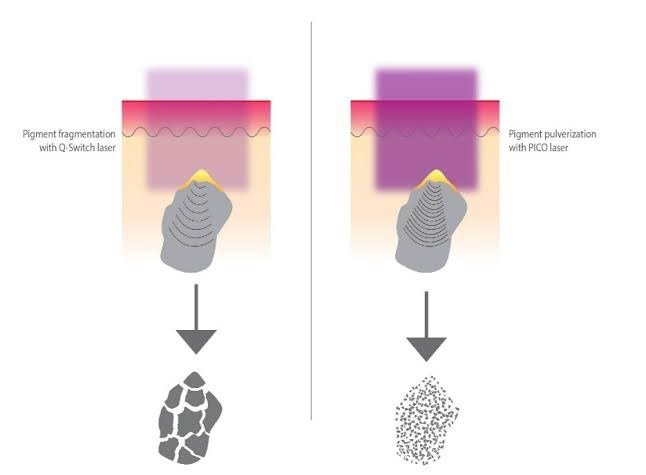 แนะนำเทคนิคเลเซอร์ลบรอยสักด้วย Picosecond Laser: ลบรอยสักด้วยเลเซอร์ Discovery Picosecond Laser มีเทคนิคอย่างไร ? แนะนำเทคนิคเลเซอร์ลบรอยสักด้วย Picosecond Laser: ลบรอยสักด้วยเลเซอร์ Discovery Picosecond Laser มีเทคนิคอย่างไร ?