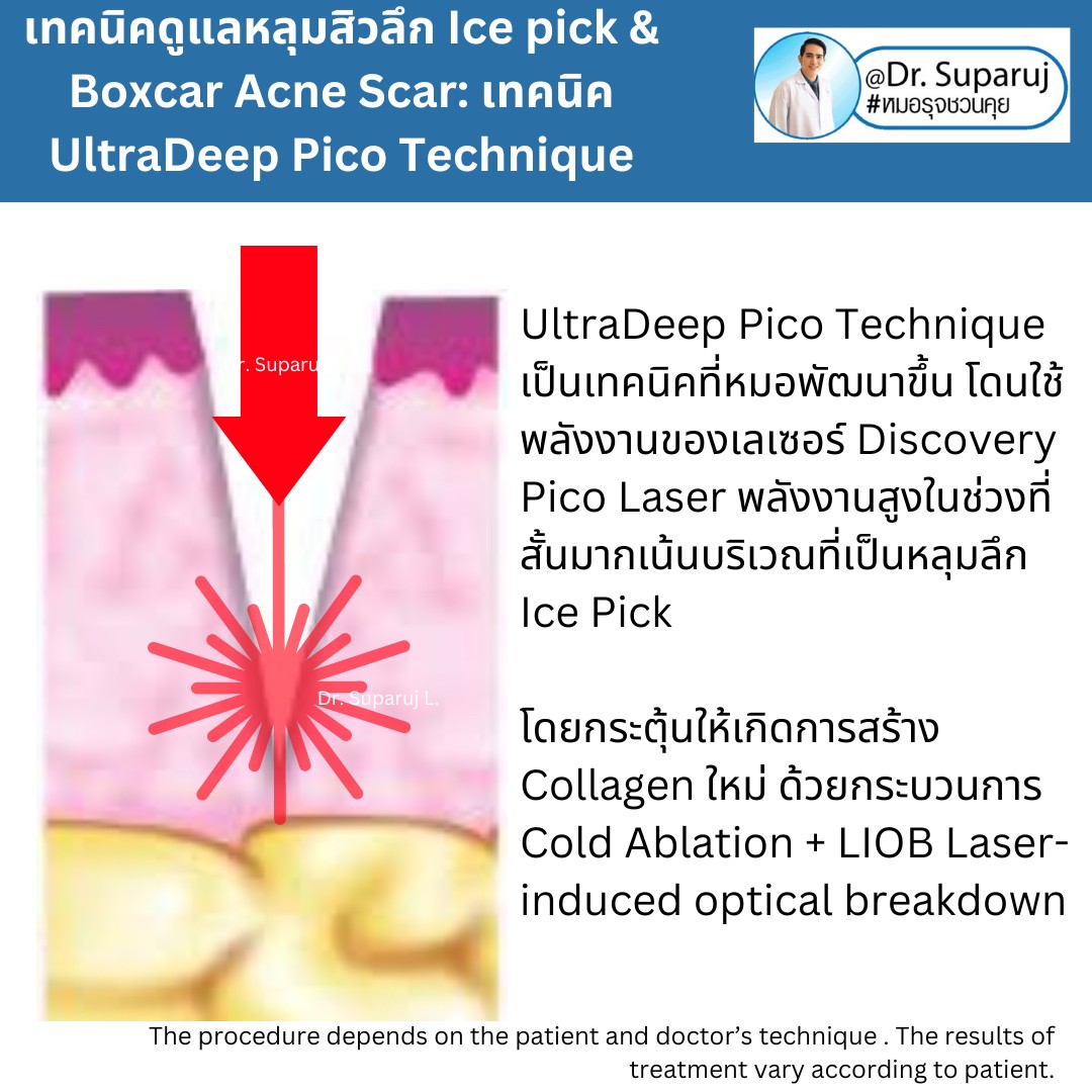 แนะนำเทคนิครักษาหลุมสิวจิกลึก Ice Pick Acne Scar ด้วยเทคนิคเลเซอร์ UltraDeep Pico Technique (Ice Pick Acne Scar Treatment with Discovery Pico Laser + UltraDeep Pico Technique)  แนะนำเทคนิครักษาหลุมสิวจิกลึก Ice Pick Acne Scar ด้วยเทคนิคเลเซอร์ UltraDeep Pico Technique (Ice Pick Acne Scar Treatment with Discovery Pico Laser + UltraDeep Pico Technique)
