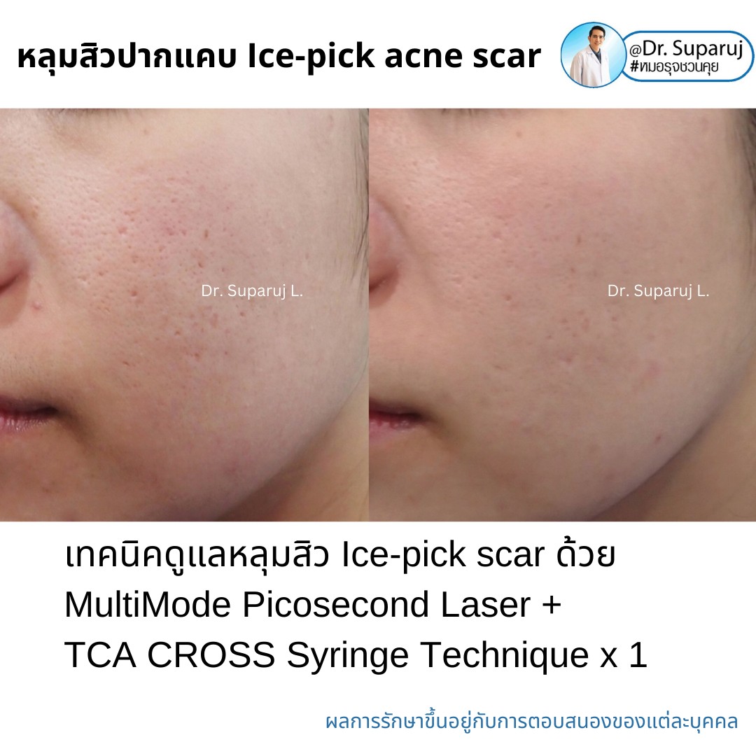 แนะนำเทคนิครักษาหลุมสิวจิกลึก Ice Pick Acne Scar ด้วยเทคนิคเลเซอร์ UltraDeep Pico Technique (Ice Pick Acne Scar Treatment with Discovery Pico Laser + UltraDeep Pico Technique)  แนะนำเทคนิครักษาหลุมสิวจิกลึก Ice Pick Acne Scar ด้วยเทคนิคเลเซอร์ UltraDeep Pico Technique (Ice Pick Acne Scar Treatment with Discovery Pico Laser + UltraDeep Pico Technique)