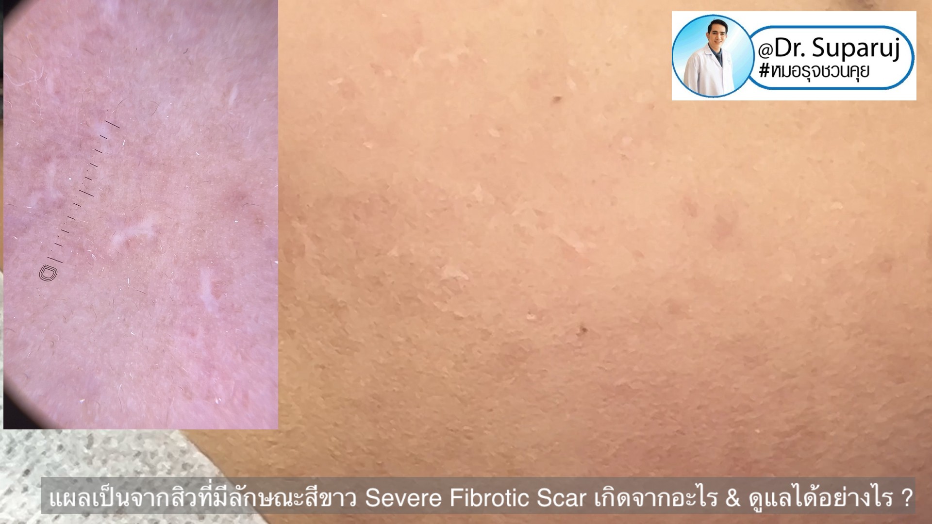 แผลเป็นจากสิวที่มีลักษณะสีขาว severe fibrotic acne scar เกิดจากอะไร & ดูแลได้อย่างไร ?