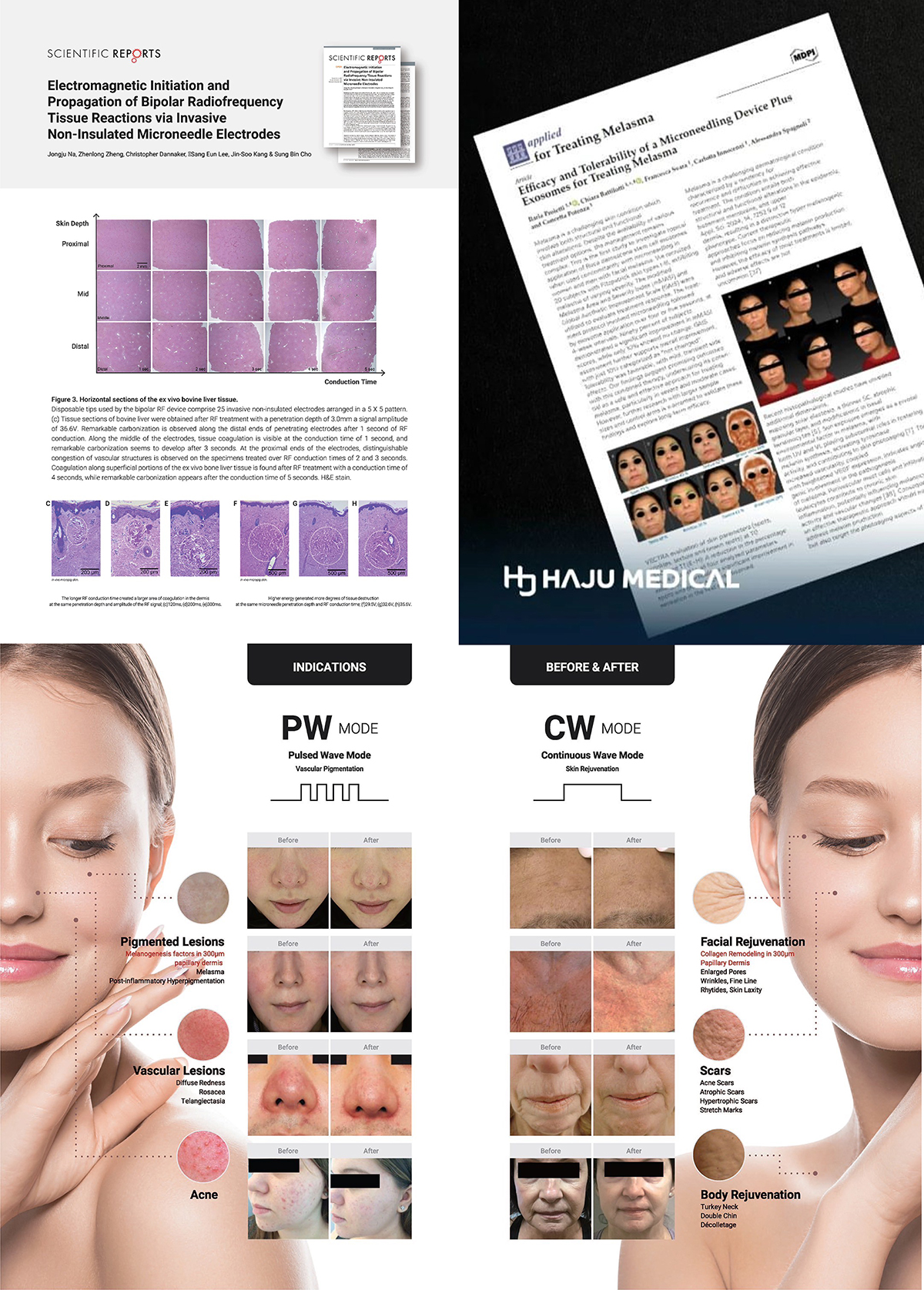 รักษาฝ้า ด้วยการฟื้นฟูผิวด้วยการใช้ เข็มพลังงานคลื่นวิทยุโปรแกรม SylfirmX Plus + โปรแกรม Exosomes (Program SylfirmX Plus Fractional RF MicroNeedle + Program Exosomes for Melasma Skin Rehabilitation) รักษาฝ้า ด้วยการฟื้นฟูผิวด้วยการใช้ เข็มพลังงานคลื่นวิทยุโปรแกรม SylfirmX Plus + โปรแกรม Exosomes (Program SylfirmX Plus Fractional RF MicroNeedle + Program Exosomes for Melasma Skin Rehabilitation)