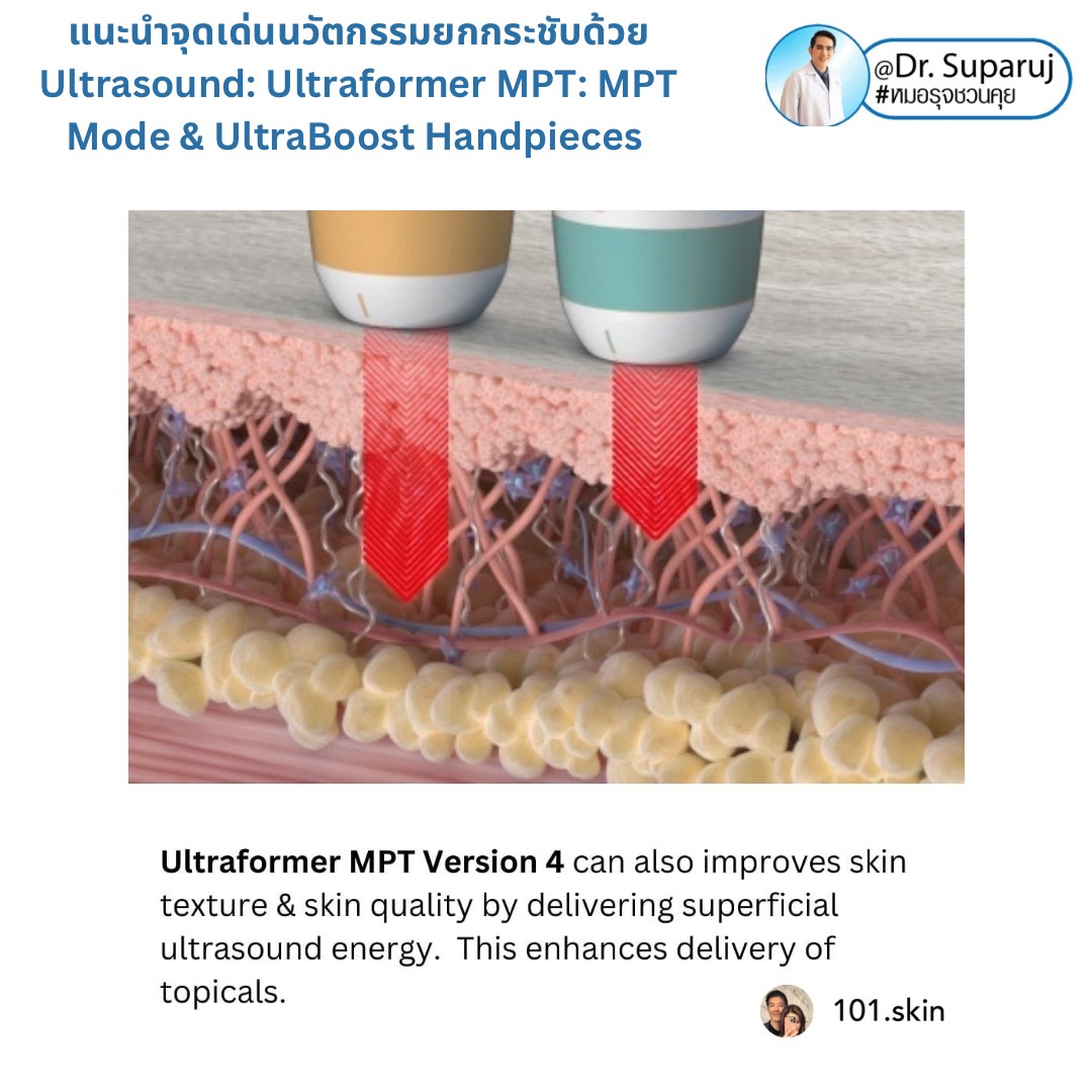 แนะนำนวัตกรรม พลังงานเครื่องเสียง Macro & Micro Focused Ultrasound ยกกระชับผิว Ultraformer MPT: จุดเด่น + ทดสอบลักษณะพลังงาน + การประเมินลักษณะผิว ให้เห็นกันชัดๆเลยครับ