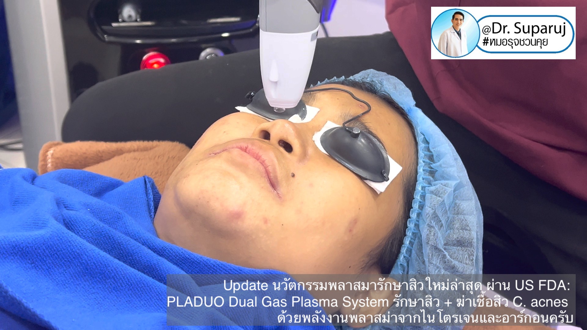 Update นวัตกรรมพลาสมารักษาสิวใหม่ล่าสุด ผ่าน US FDA: PLADUO Dual Gas Plasma System ช่วยรักษาสิว + ฆ่าเชื้อสิว C. acnes + รักษาหลุมสิว รอยดำ รอยแดง