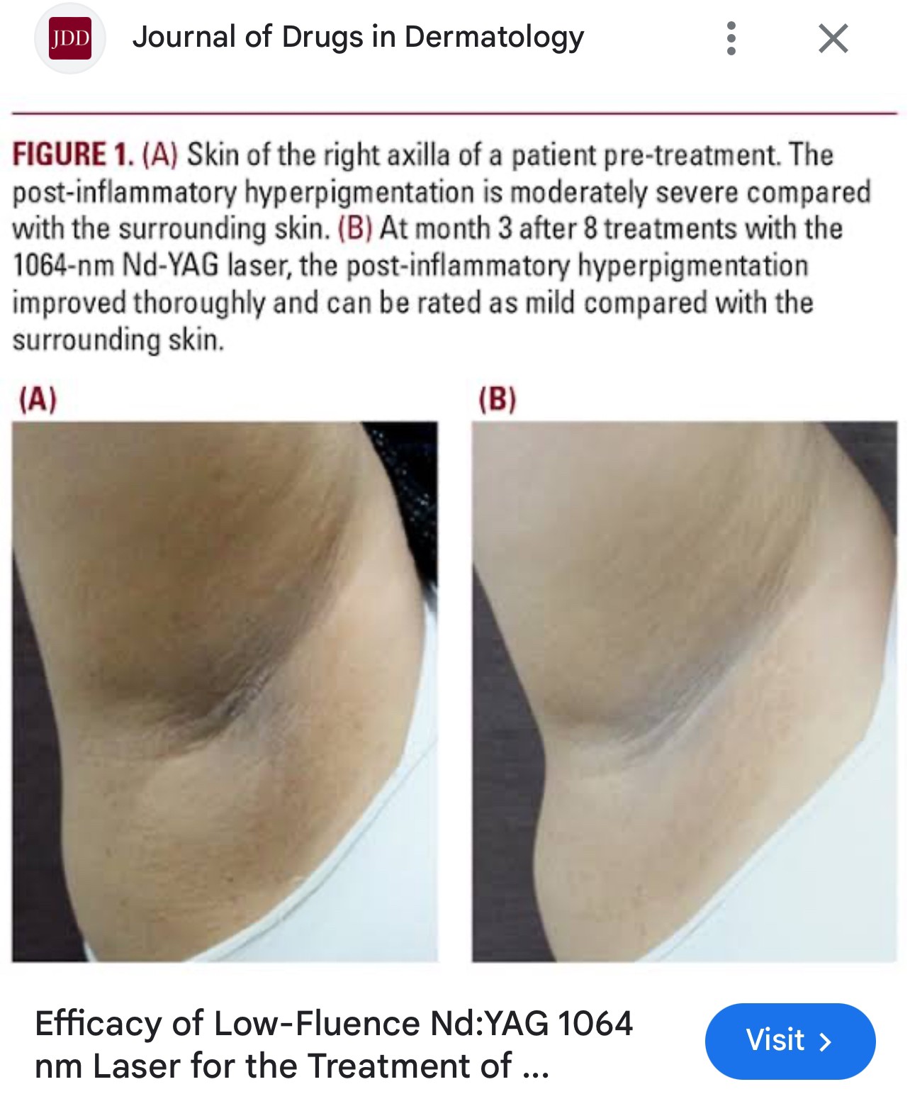 รักแร้ดำเกิดจากสาเหตุอะไร & ดูแลอย่างไร ? รักแร้ดำเกิดจากสาเหตุอะไร & ดูแลอย่างไร ?