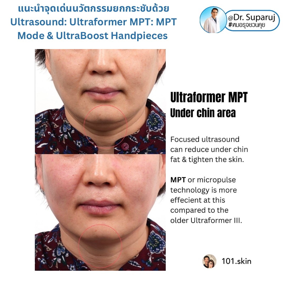 แนะนำนวัตกรรม พลังงานเครื่องเสียง Macro & Micro Focused Ultrasound ยกกระชับผิว Ultraformer MPT: จุดเด่น + ทดสอบลักษณะพลังงาน + การประเมินลักษณะผิว ให้เห็นกันชัดๆเลยครับ