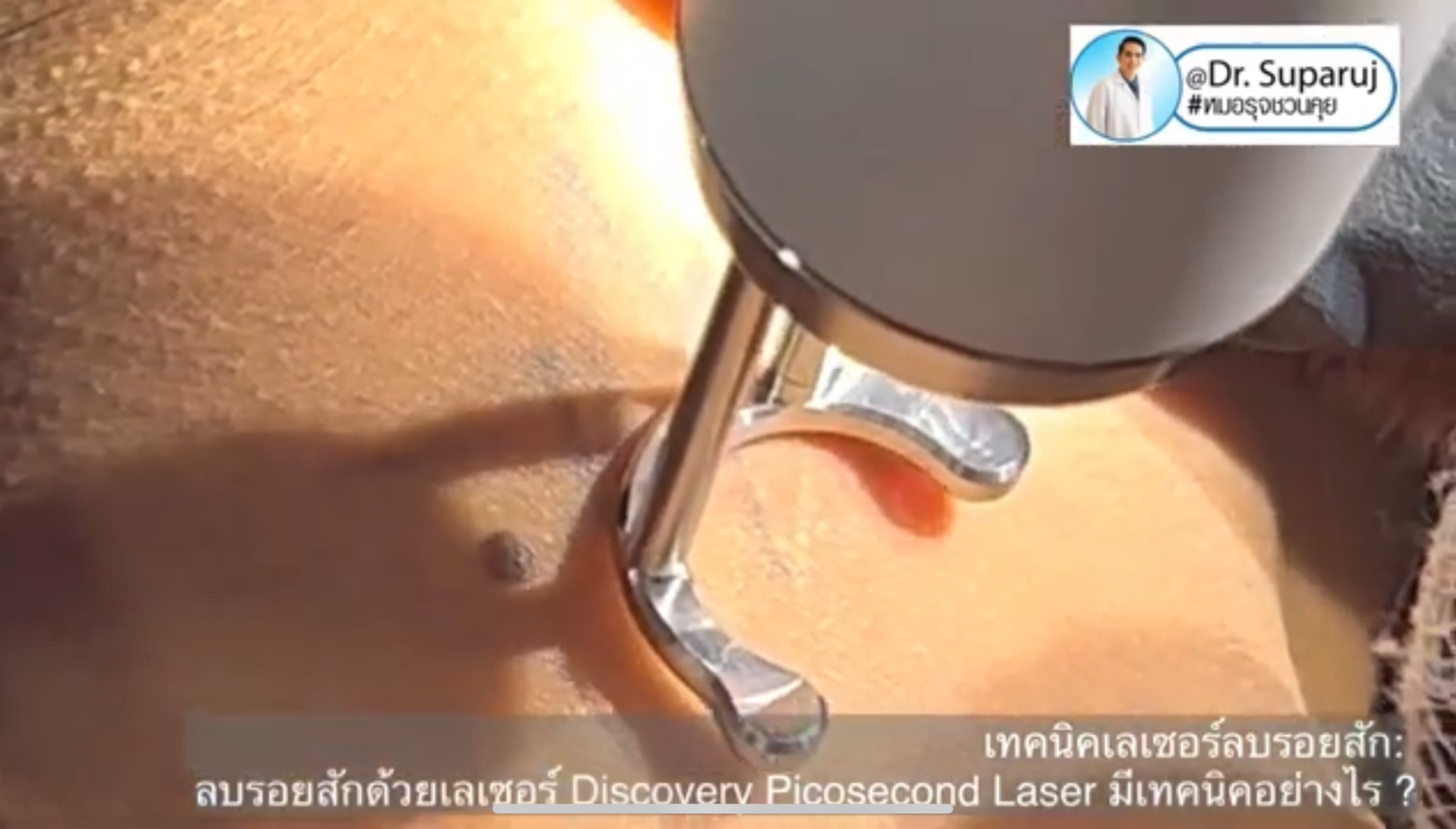 ทำไมต้องลบรอยสักด้วย พิโค่เลเซอร์ Picosecond Laser ทำไมต้องลบรอยสักด้วย พิโค่เลเซอร์ Picosecond Laser