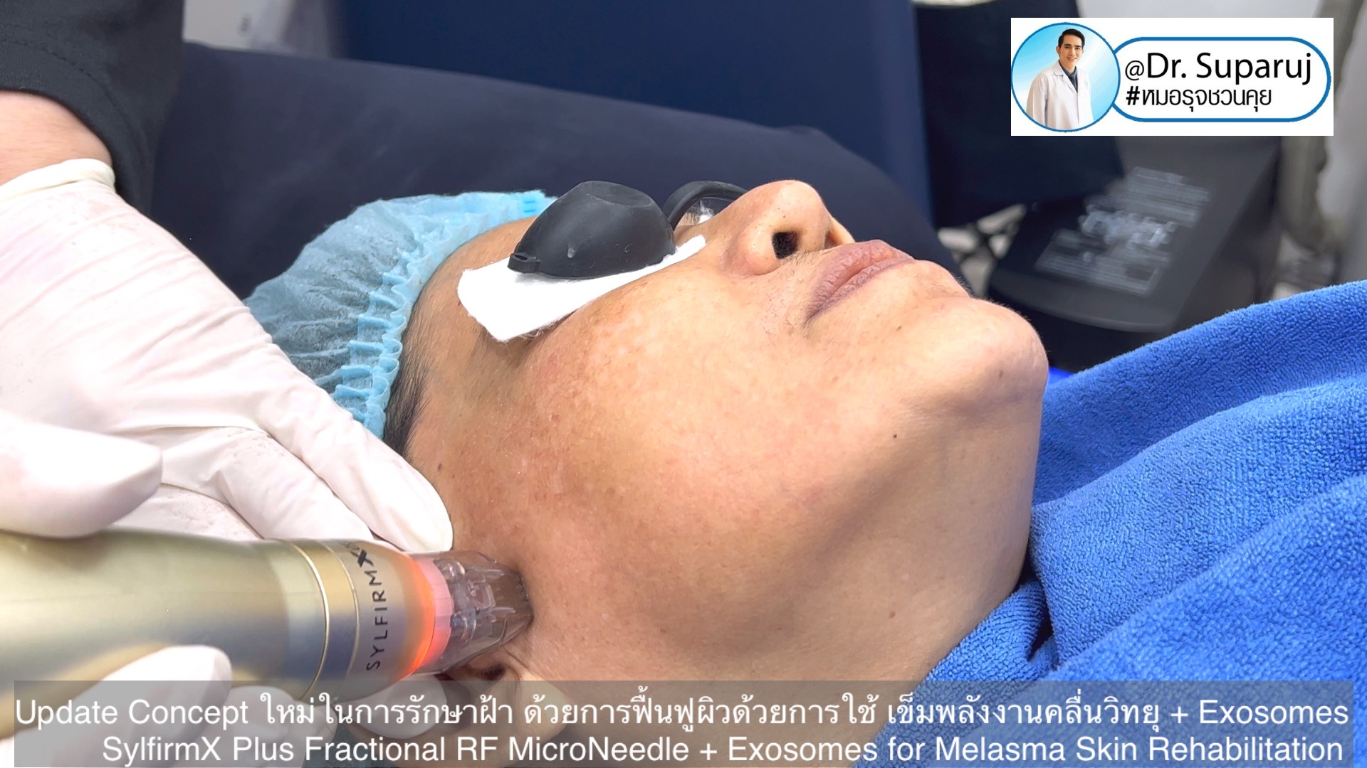 Update Concept ใหม่ในการรักษาฝ้า ด้วยการฟื้นฟูผิวด้วยการใช้ เข็มพลังงานคลื่นวิทยุ + Exosomes (SylfirmX Plus Fractional RF MicroNeedle + Exosomes for Melasma Skin Rehabilitation) Update Concept ใหม่ในการรักษาฝ้า ด้วยการฟื้นฟูผิวด้วยการใช้ เข็มพลังงานคลื่นวิทยุ + Exosomes (SylfirmX Plus Fractional RF MicroNeedle + Exosomes for Melasma Skin Rehabilitation)