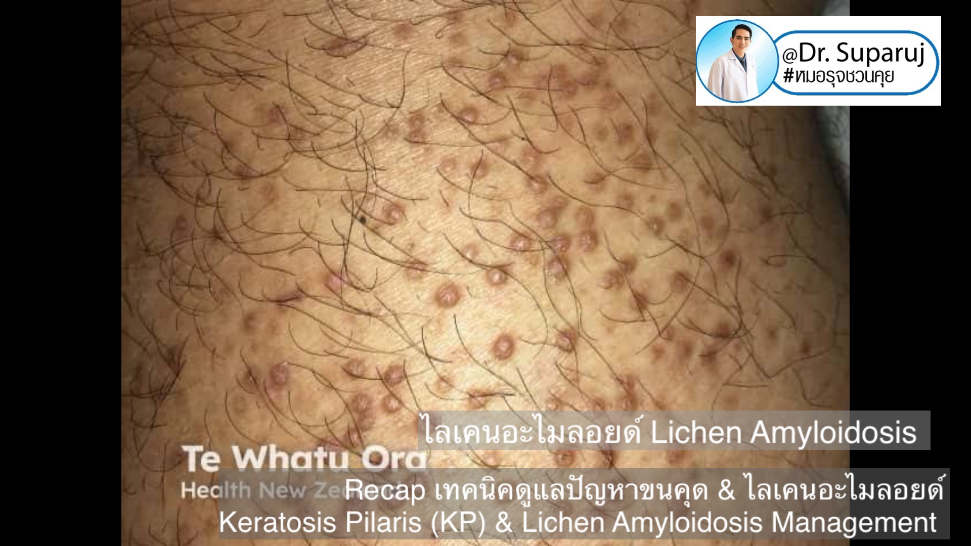 Recap เทคนิคดูแลปัญหาขนคุด & ไลเคนอะไมลอยด์  Keratosis Pilaris (KP) & Lichen Amyloidosis Management