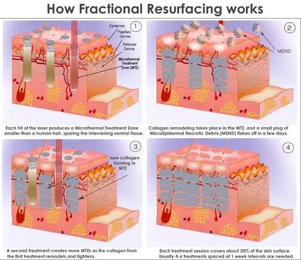 โปรแกรมเลเซอร์ Fractional CO2 Laser ยังใช้รักษาหลุมสิวได้อยู่ไหม ?