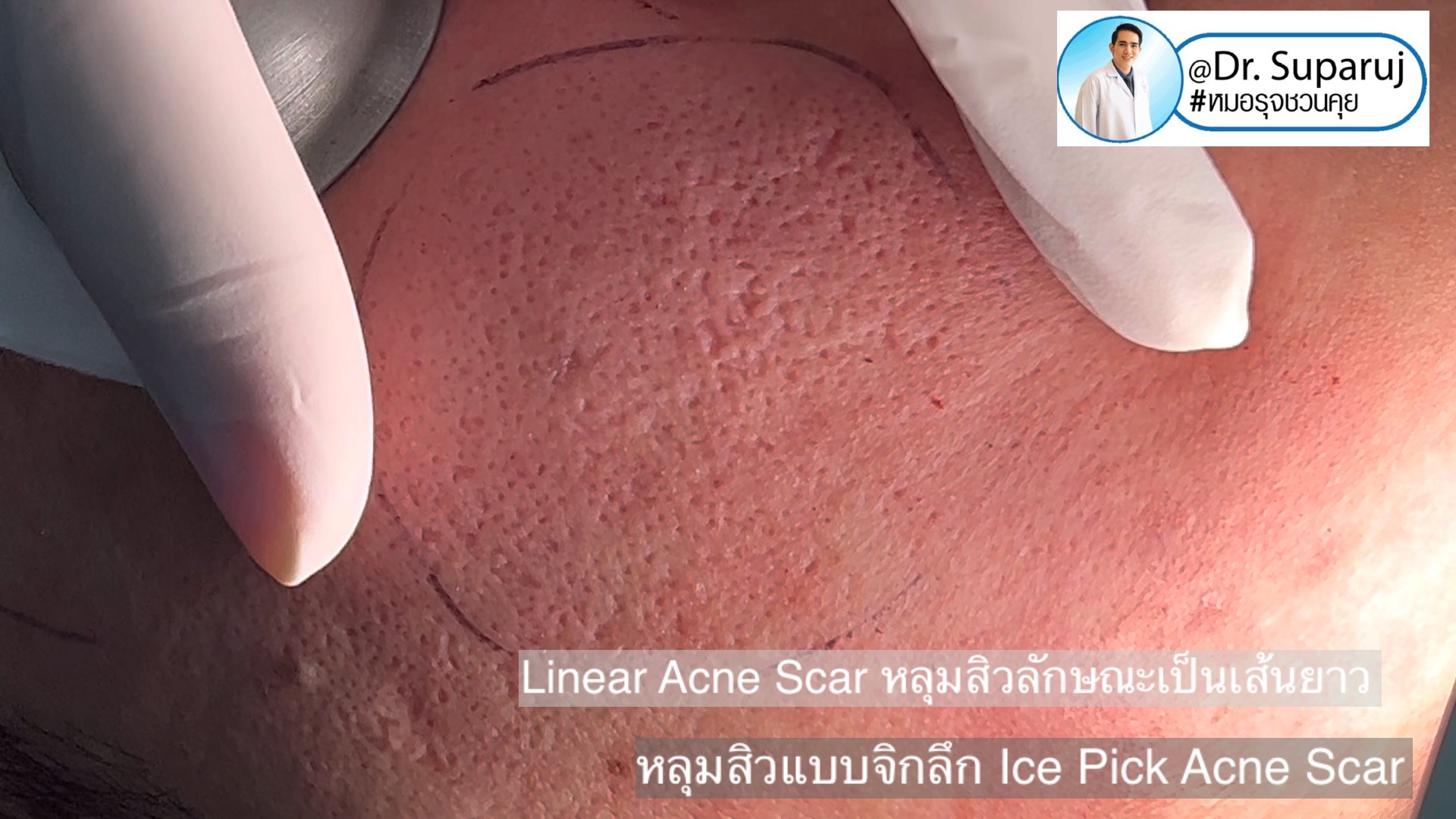 Back to the Basics: หลุมสิวมีกี่ชนิด & มีลักษณะอย่างไร ? Acne Scar Classification Full Clip คลิปเต็ม Facebook/ YouTube Dr. Suparuj หมอรุจชวนคุย ครับ Back to the Basics: หลุมสิวมีกี่ชนิด & มีลักษณะอย่างไร ? Acne Scar Classification Full Clip คลิปเต็ม Facebook/ YouTube Dr. Suparuj หมอรุจชวนคุย ครับ
