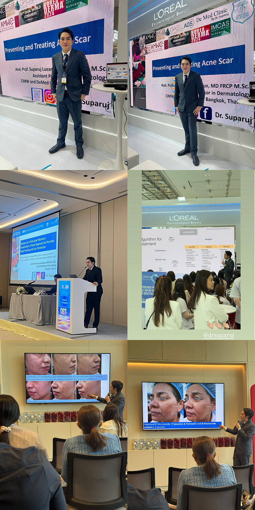 หมอรุจเป็นวิทยากรบรรยายการ รักษาผมร่วงผมบาง การใช้เลเซอร์ และ โปรแกรมexosomes AMWC ASIA 2025 ครับ AESTHETIC & ANTI-AGING MEDICINE WORLD CONGRESS ASIA AMWC TAIPEI 2025 TW