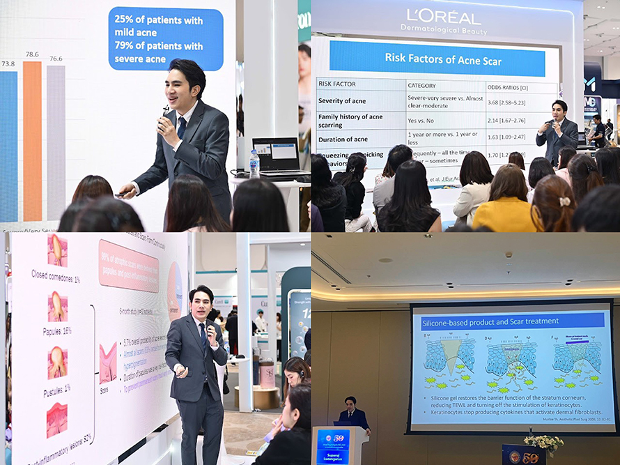 หมอรุจเป็นวิทยากรบรรยายการ รักษาผมร่วงผมบาง การใช้เลเซอร์ และ โปรแกรมexosomes AMWC ASIA 2025 ครับ AESTHETIC & ANTI-AGING MEDICINE WORLD CONGRESS ASIA AMWC TAIPEI 2025 TW