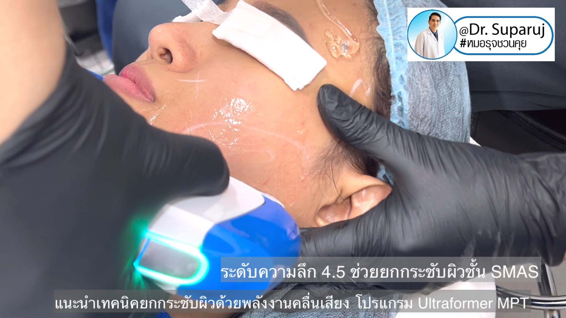 แนะนำเทคนิคยกกระชับผิว ด้วยพลังงานคลื่นเสียง MMFU Focused Ultrasound โปรแกรม Ultraformer MPT