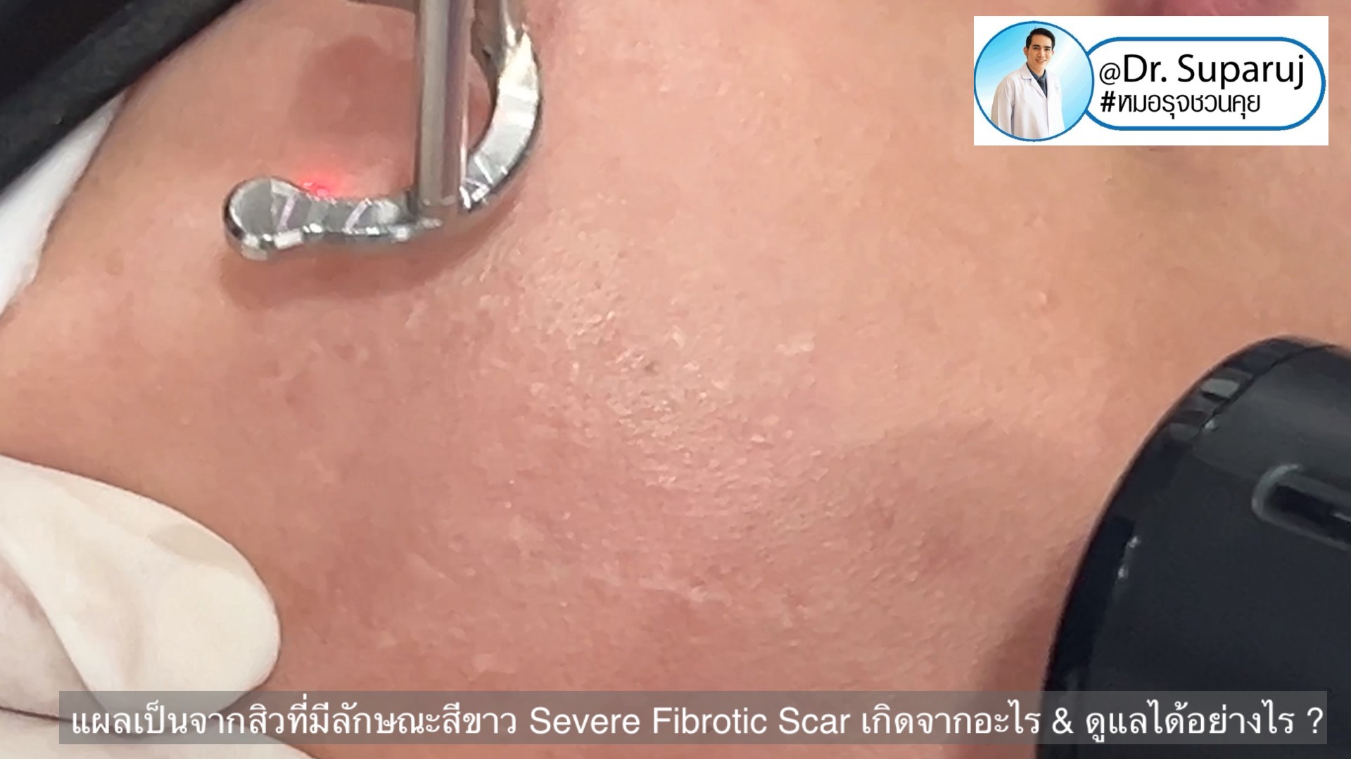 แผลเป็นจากสิวที่มีลักษณะสีขาว severe fibrotic acne scar เกิดจากอะไร & ดูแลได้อย่างไร ? แผลเป็นจากสิวที่มีลักษณะสีขาว severe fibrotic acne scar เกิดจากอะไร & ดูแลได้อย่างไร ?