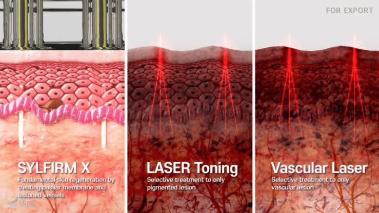 Update Concept ใหม่ในการรักษาฝ้า ด้วยการฟื้นฟูผิวด้วยการใช้ เข็มพลังงานคลื่นวิทยุ + Exosomes (SylfirmX Plus Fractional RF MicroNeedle + Exosomes for Melasma Skin Rehabilitation) Update Concept ใหม่ในการรักษาฝ้า ด้วยการฟื้นฟูผิวด้วยการใช้ เข็มพลังงานคลื่นวิทยุ + Exosomes (SylfirmX Plus Fractional RF MicroNeedle + Exosomes for Melasma Skin Rehabilitation)