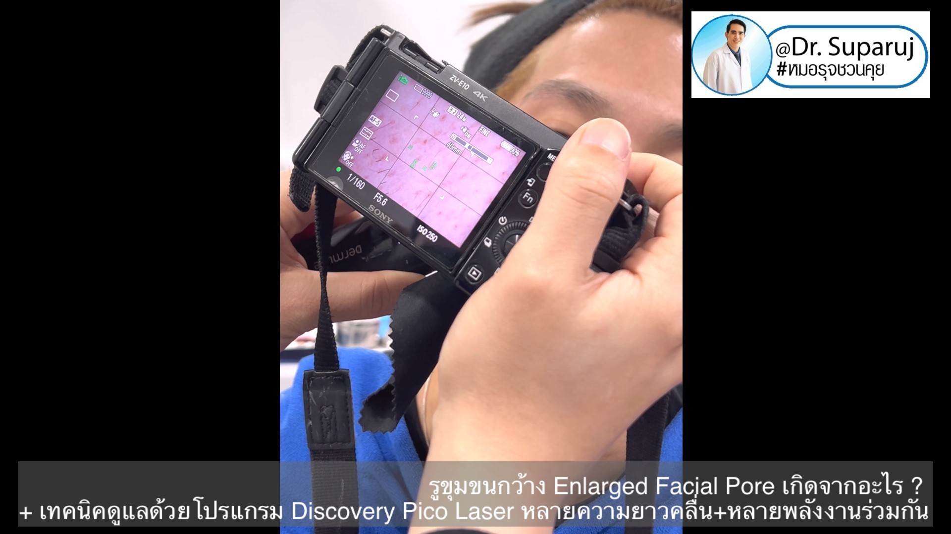 รูขุมขนกว้าง Enlarged Facial Pore เกิดจากอะไร ? + เทคนิคดูแลด้วยโปรแกรม Discovery Pico Laser หลายความยาวคลื่น +หลายพลังงานร่วมกัน รูขุมขนกว้าง Enlarged Facial Pore เกิดจากอะไร ? + เทคนิคดูแลด้วยโปรแกรม Discovery Pico Laser หลายความยาวคลื่น +หลายพลังงานร่วมกัน