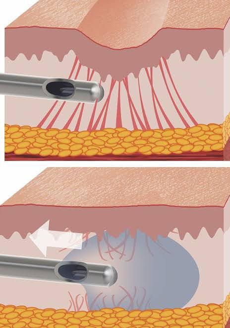 Update เทคนิค Subcision ตัดพังผืดรักษาหลุมสิว Acne Scar Subcision Techniques Update เทคนิค Subcision ตัดพังผืดรักษาหลุมสิว Acne Scar Subcision Techniques
