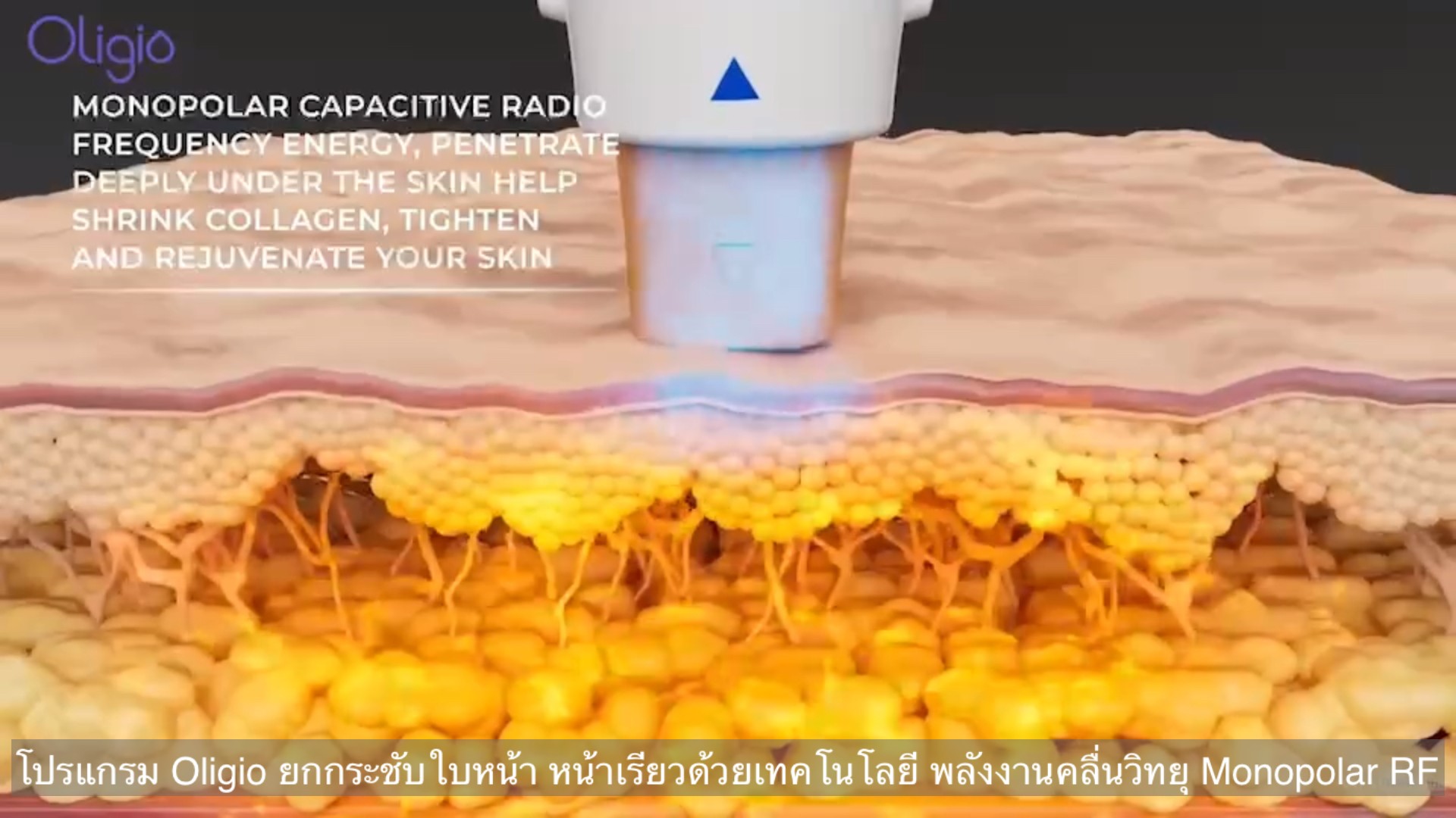 ยกกระชับผิวหน้าด้วย โปรแกรม Oligio Monopolar RF มีกลไก& จุดเด่น อย่างไร ? ยกกระชับผิวหน้าด้วย โปรแกรม Oligio Monopolar RF มีกลไก& จุดเด่น อย่างไร ?