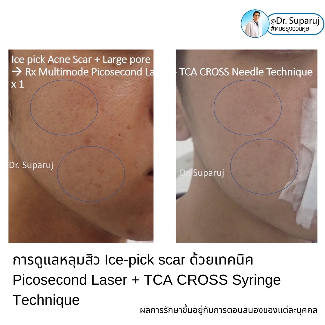 แนะนำเทคนิครักษาหลุมสิวจิกลึก Ice Pick Acne Scar ด้วยเทคนิคเลเซอร์ UltraDeep Pico Technique (Ice Pick Acne Scar Treatment with Discovery Pico Laser + UltraDeep Pico Technique)  แนะนำเทคนิครักษาหลุมสิวจิกลึก Ice Pick Acne Scar ด้วยเทคนิคเลเซอร์ UltraDeep Pico Technique (Ice Pick Acne Scar Treatment with Discovery Pico Laser + UltraDeep Pico Technique)