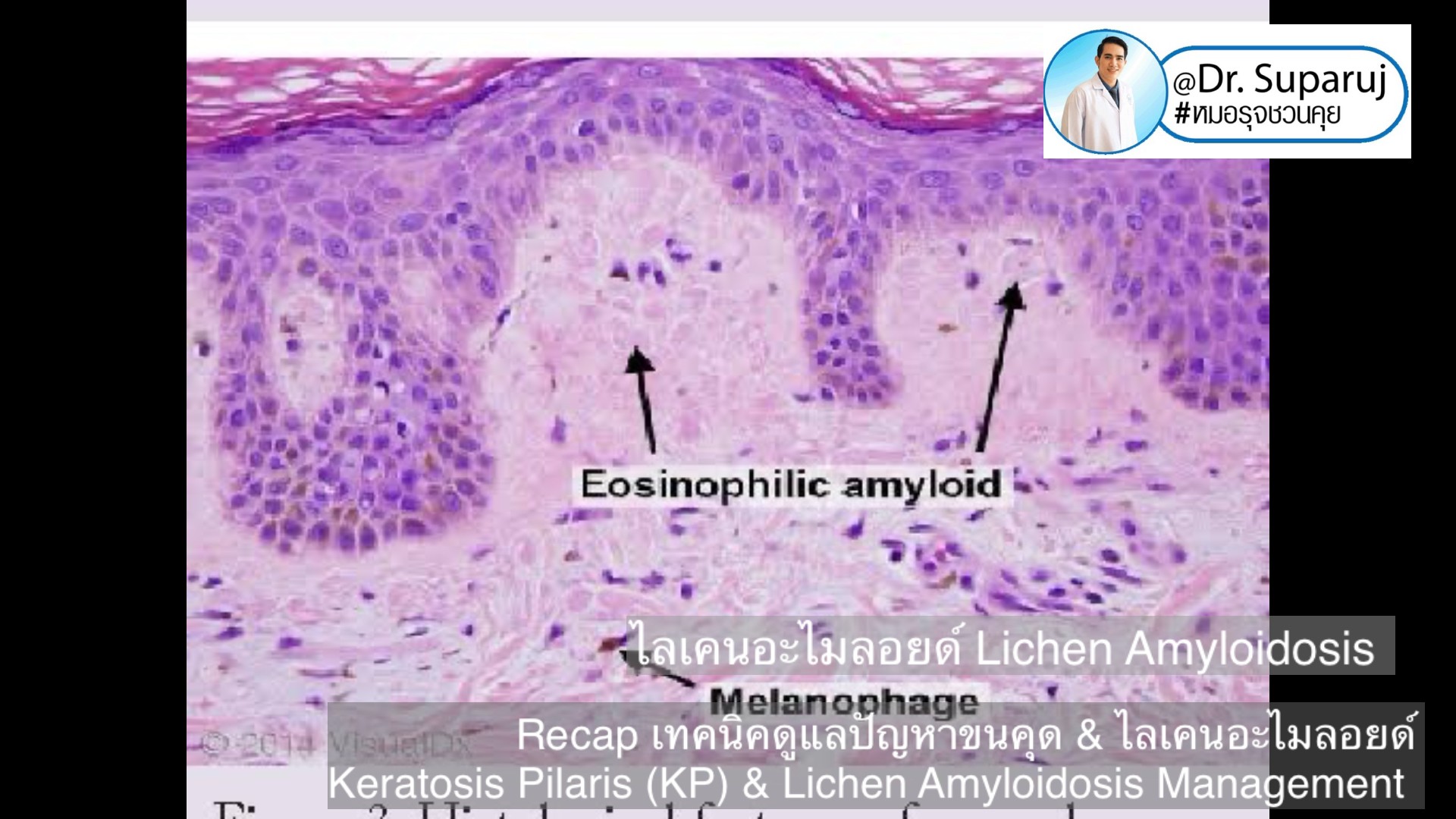 Recap เทคนิคดูแลปัญหาขนคุด & ไลเคนอะไมลอยด์ Keratosis Pilaris (KP) & Lichen Amyloidosis Management Recap เทคนิคดูแลปัญหาขนคุด & ไลเคนอะไมลอยด์ Keratosis Pilaris (KP) & Lichen Amyloidosis Management