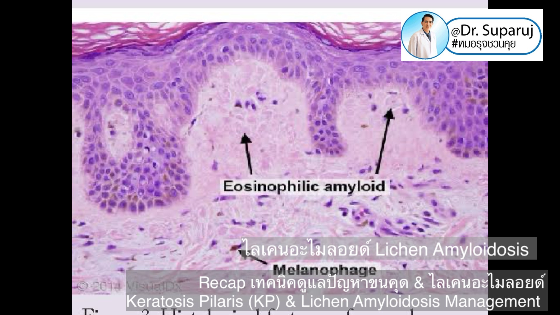 Recap เทคนิคดูแลปัญหาขนคุด & ไลเคนอะไมลอยด์  Keratosis Pilaris (KP) & Lichen Amyloidosis Management