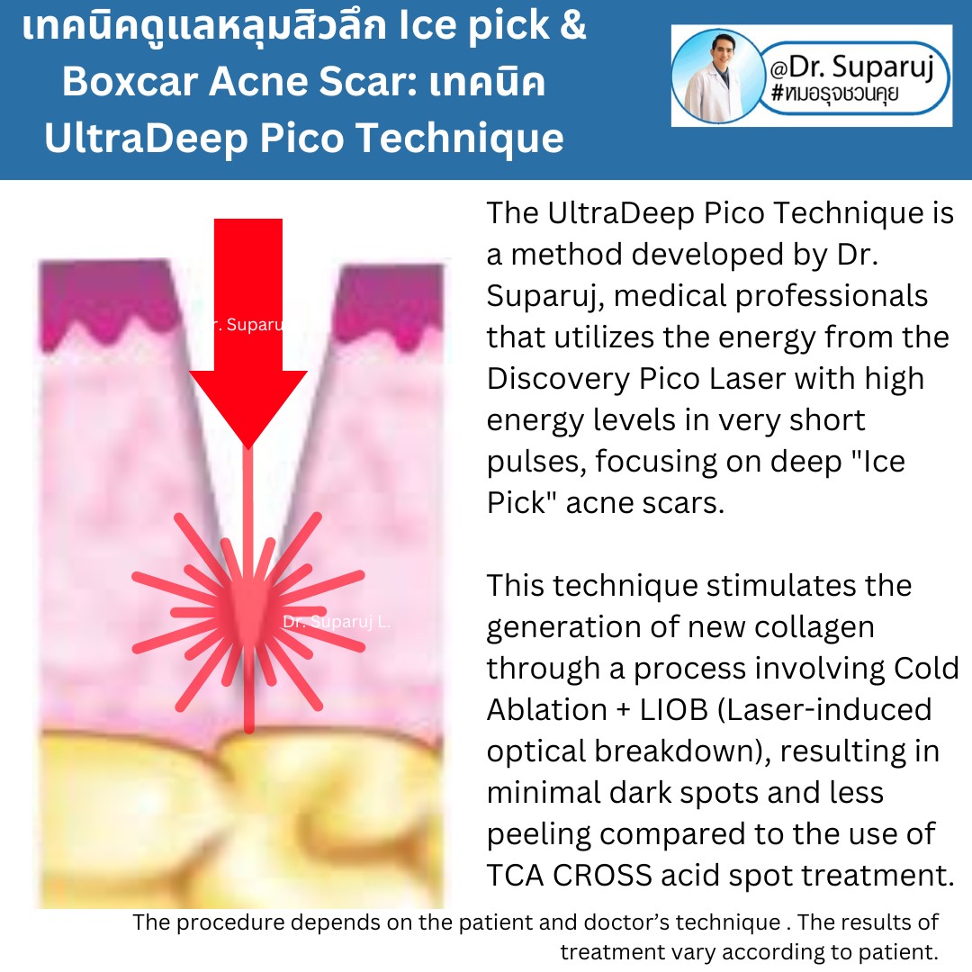 แนะนำเทคนิครักษาหลุมสิวจิกลึก Ice Pick Acne Scar ด้วยเทคนิคเลเซอร์ UltraDeep Pico Technique (Ice Pick Acne Scar Treatment with Discovery Pico Laser + UltraDeep Pico Technique)  แนะนำเทคนิครักษาหลุมสิวจิกลึก Ice Pick Acne Scar ด้วยเทคนิคเลเซอร์ UltraDeep Pico Technique (Ice Pick Acne Scar Treatment with Discovery Pico Laser + UltraDeep Pico Technique)