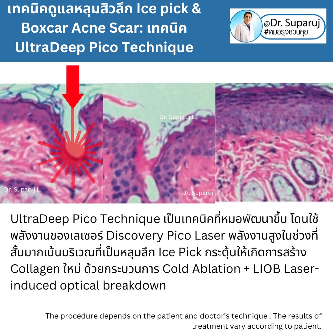 แนะนำเทคนิครักษาหลุมสิวจิกลึก Ice Pick Acne Scar ด้วยเทคนิคเลเซอร์ UltraDeep Pico Technique (Ice Pick Acne Scar Treatment with Discovery Pico Laser + UltraDeep Pico Technique)  แนะนำเทคนิครักษาหลุมสิวจิกลึก Ice Pick Acne Scar ด้วยเทคนิคเลเซอร์ UltraDeep Pico Technique (Ice Pick Acne Scar Treatment with Discovery Pico Laser + UltraDeep Pico Technique)
