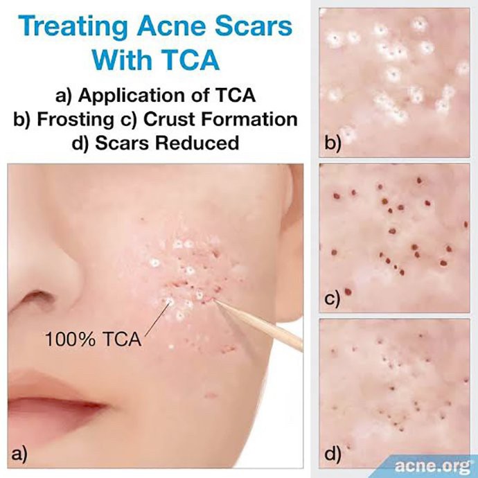 Update เทคนิครักษาหลุมสิว: หลุมสิวแบบจิกลึก Ice Pick Acne Scar มีลักษณะ & ดูแลได้อย่างไร ?