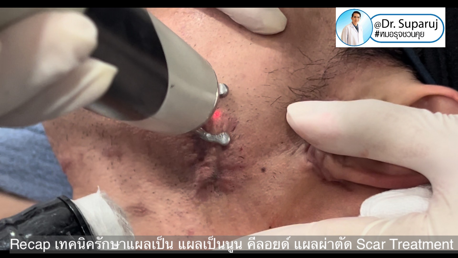 Recap เทคนิครักษาแผลเป็น แผลเป็นนูน คีลอยด์ แผลผ่าตัด Scar Treatment