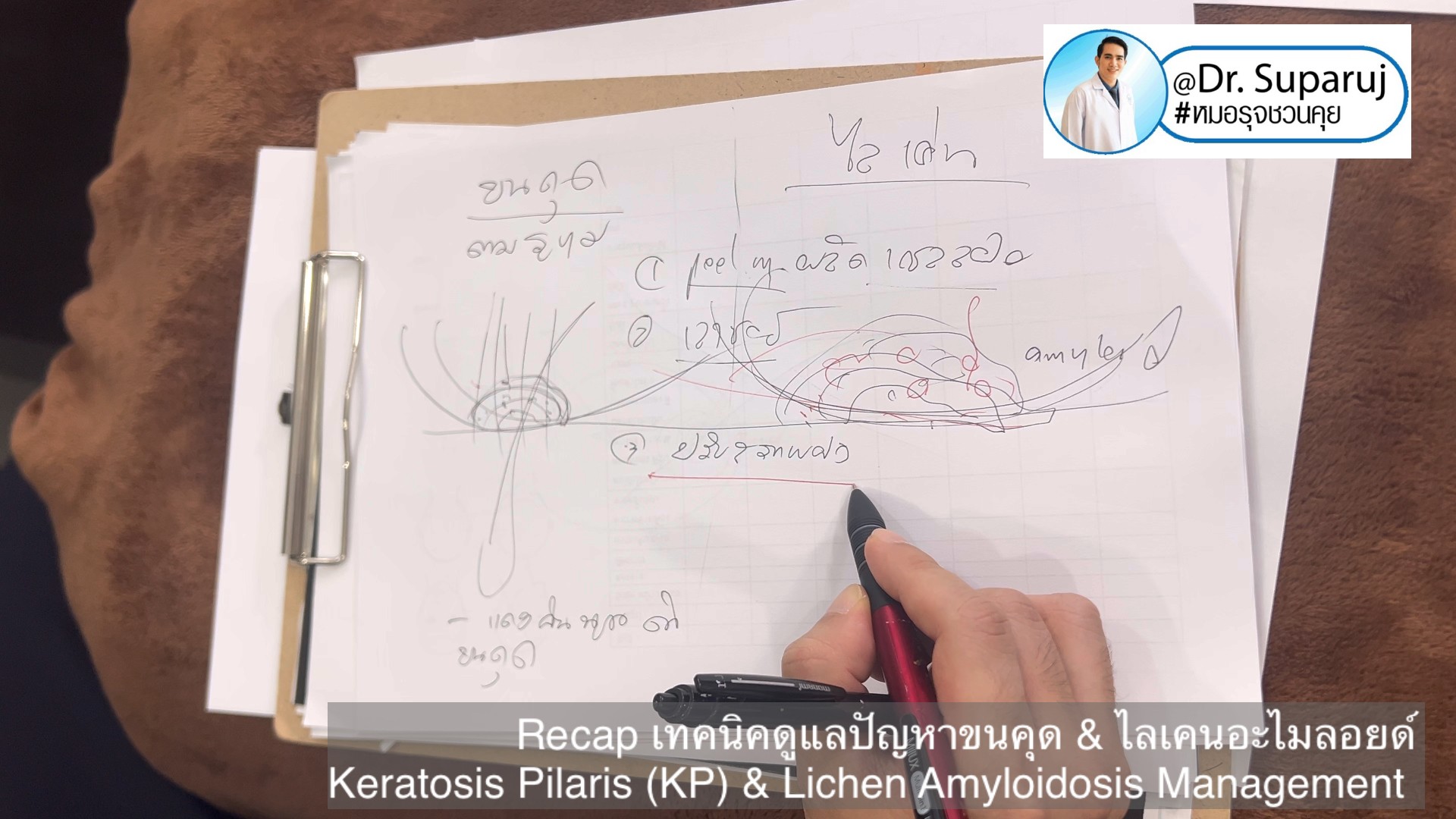 Recap เทคนิคดูแลปัญหาขนคุด & ไลเคนอะไมลอยด์  Keratosis Pilaris (KP) & Lichen Amyloidosis Management