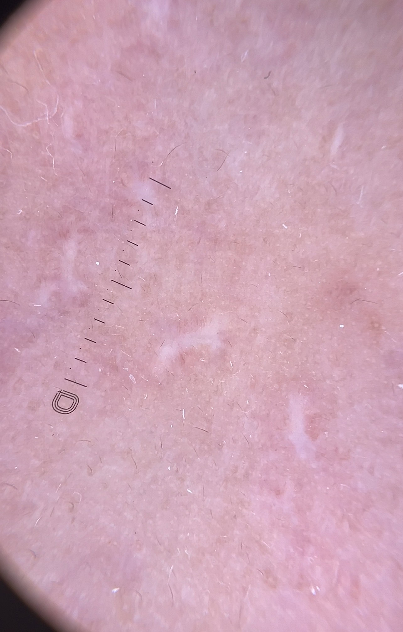 แผลเป็นจากสิวที่มีลักษณะสีขาว severe fibrotic acne scar เกิดจากอะไร & ดูแลได้อย่างไร ?