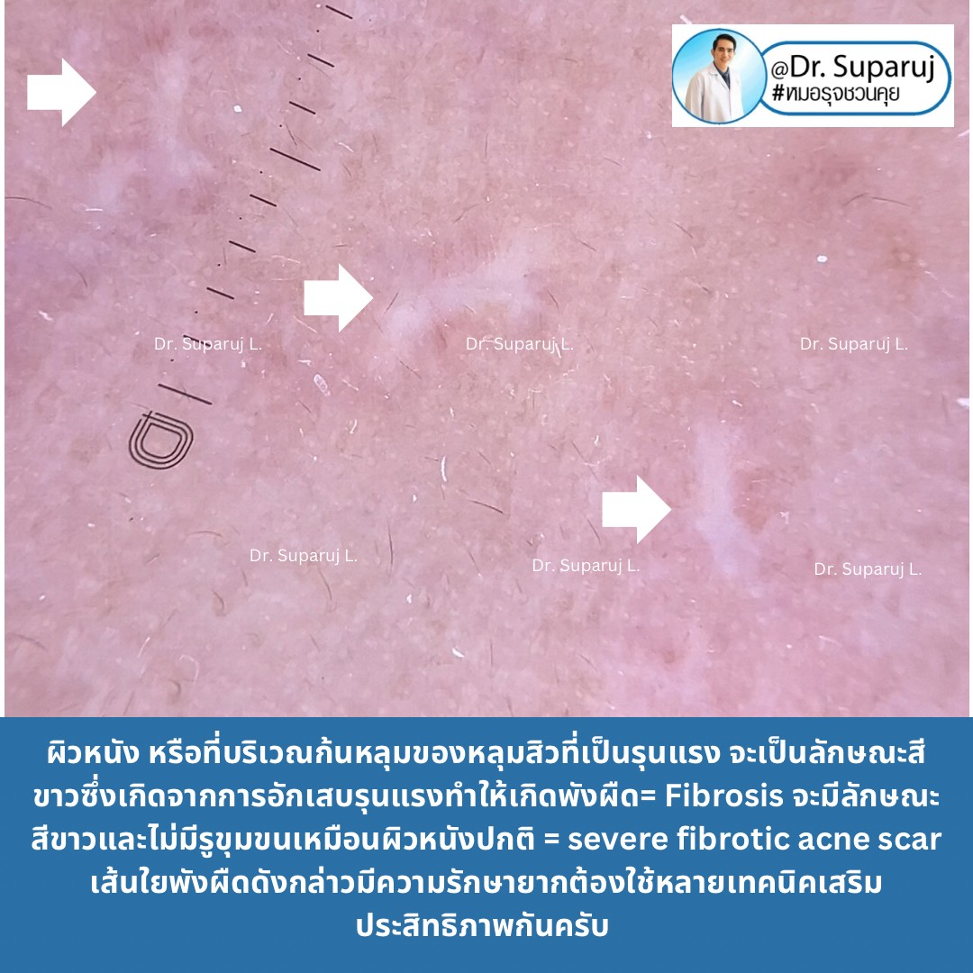 แผลเป็นจากสิวที่มีลักษณะสีขาว severe fibrotic acne scar เกิดจากอะไร & ดูแลได้อย่างไร ?