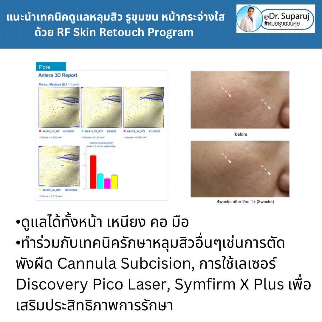 แนะนำเทคนิคดูแลหลุมสิว รูขุมขน หน้ากระจ่างใสด้วย RF Skin Retouch Program แนะนำเทคนิคดูแลหลุมสิว รูขุมขน หน้ากระจ่างใสด้วย RF Skin Retouch Program