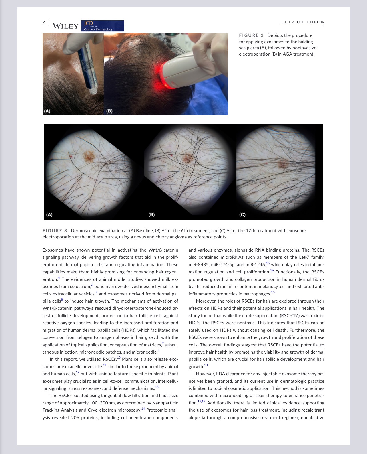 งานวิจัยล่าสุดโดย ผศ. นพ. ศุภะรุจ เลื่องอรุณ (หมอรุจ) และ รศ. นพ. เทอดพงศ์ เต็มภาคย์ ที่ตีพิมพ์ใน Journal of Cosmetic Dermatology ศึกษาการใช้เอ็กโซโซมที่ได้จากเซลล์ต้นกำเนิดของดอกกุหลาบเพื่อเสริมการฟื้นฟูเส้นผมโดยการใช้อิเล็กโทรโพเรชั่นในผู้ป่วยที่มีภาวะ ผมบางจากพันธุกรรม AGA***โดยไม่ใช้ยา การฉีด เลเซอร์ หรือ RF***ครับ งานวิจัยล่าสุดโดย ผศ. นพ. ศุภะรุจ เลื่องอรุณ (หมอรุจ) และ รศ. นพ. เทอดพงศ์ เต็มภาคย์ ที่ตีพิมพ์ใน Journal of Cosmetic Dermatology ศึกษาการใช้เอ็กโซโซมที่ได้จากเซลล์ต้นกำเนิดของดอกกุหลาบเพื่อเสริมการฟื้นฟูเส้นผมโดยการใช้อิเล็กโทรโพเรชั่นในผู้ป่วยที่มีภาวะ ผมบางจากพันธุกรรม AGA***โดยไม่ใช้ยา การฉีด เลเซอร์ หรือ RF***ครับ