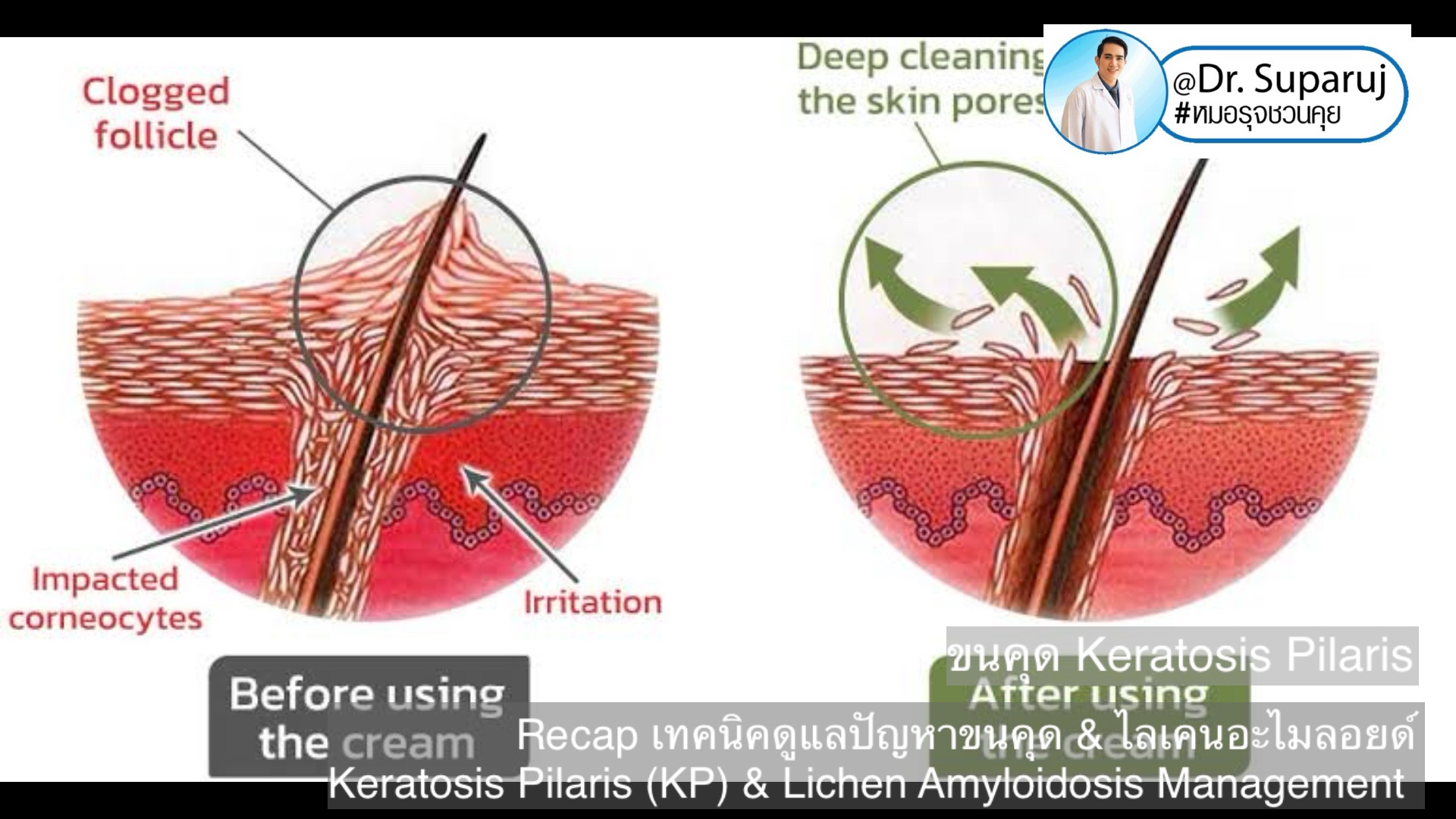 Recap เทคนิคดูแลปัญหาขนคุด & ไลเคนอะไมลอยด์  Keratosis Pilaris (KP) & Lichen Amyloidosis Management