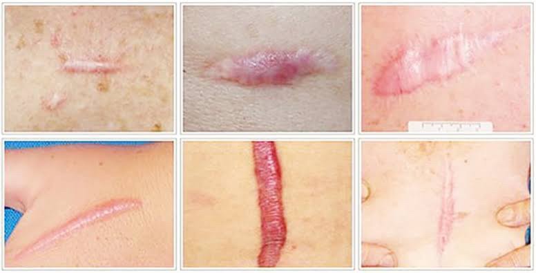 Recap เทคนิครักษาแผลเป็น แผลเป็นนูน คีลอยด์ แผลผ่าตัด Scar Treatment Recap เทคนิครักษาแผลเป็น แผลเป็นนูน คีลอยด์ แผลผ่าตัด Scar Treatment