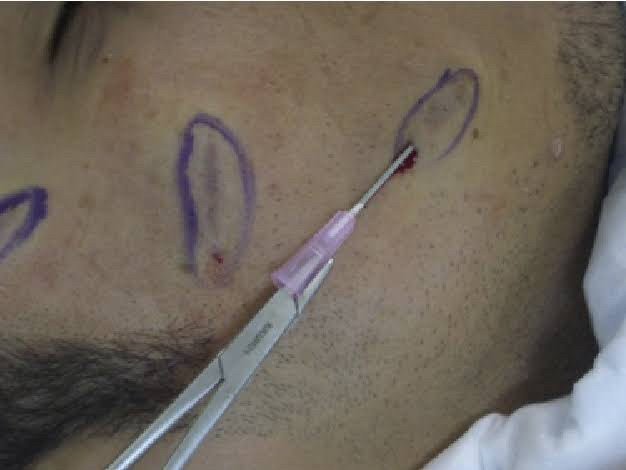 Update เทคนิค Subcision ตัดพังผืดรักษาหลุมสิว Acne Scar Subcision Techniques